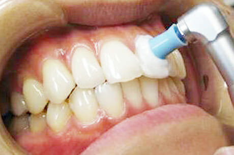 予防歯科 PMTC（Professional Mechanical Tooth Cleaning）