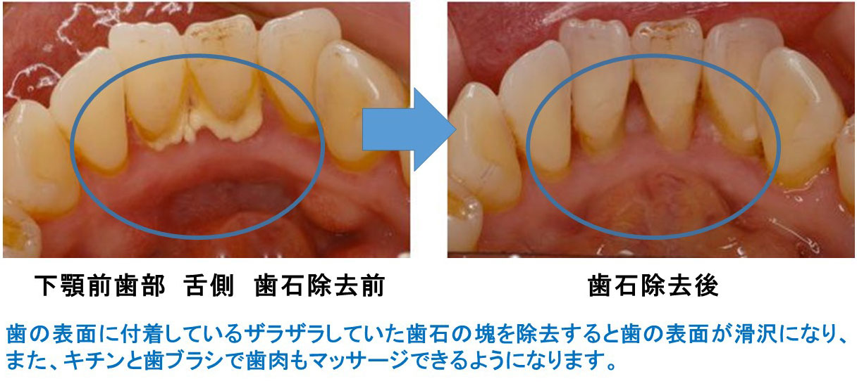 予防歯科 PMTC（Professional Mechanical Tooth Cleaning）