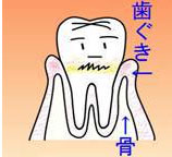 ① 歯肉炎