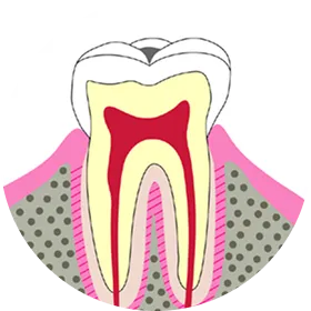 C1（初期虫歯）