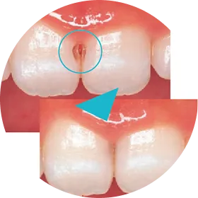 C1（初期虫歯）