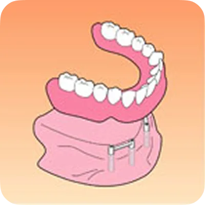 インプラント治療