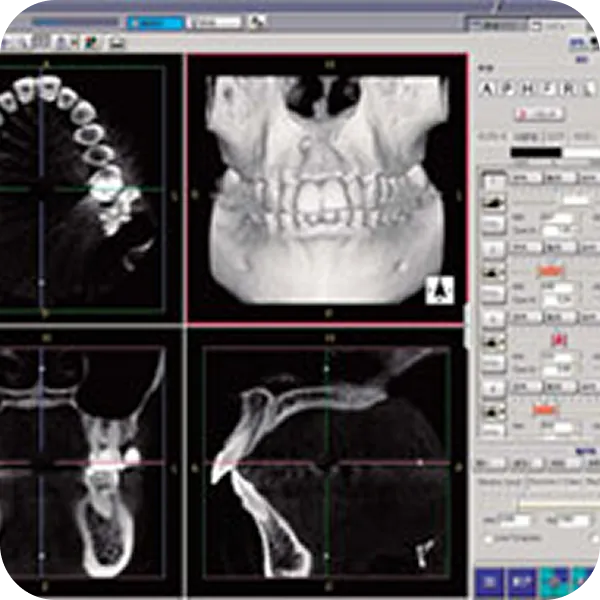 コーンビームCT2