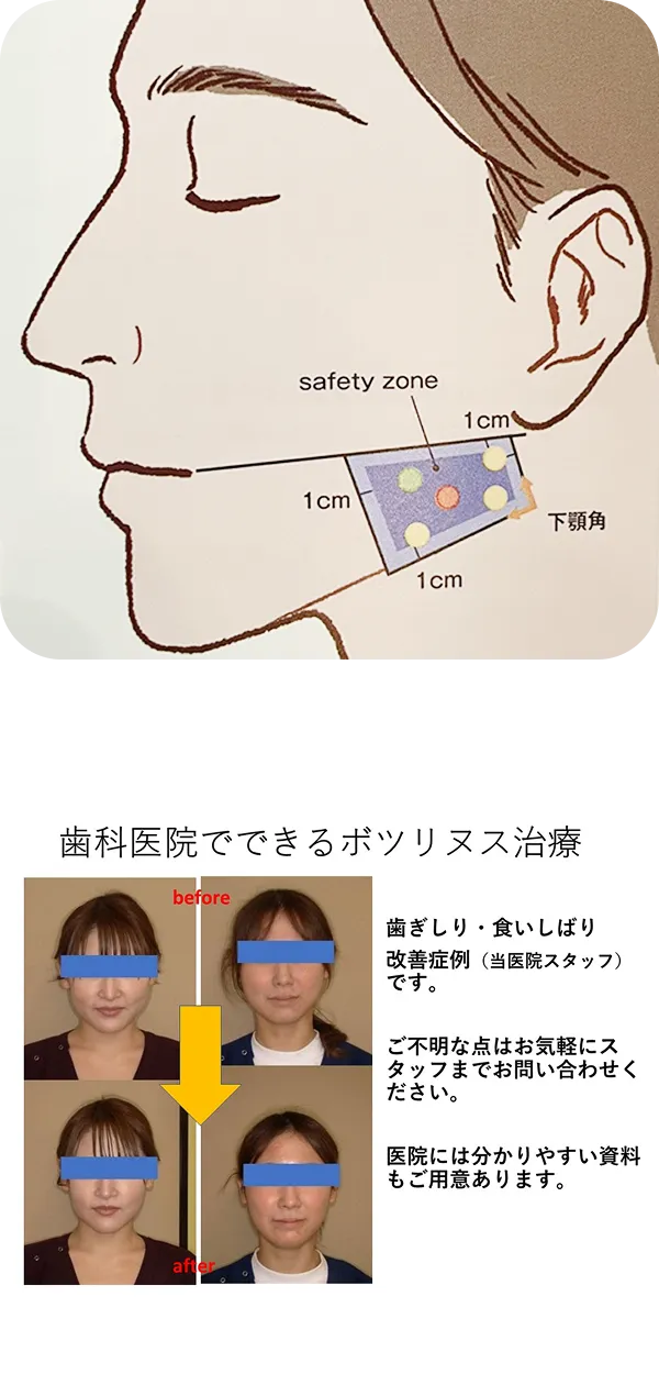当院ならではの歯ぎしり治療法